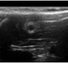 Ultrasound chitosan nerve conduit rat model sciatic nerve defects 