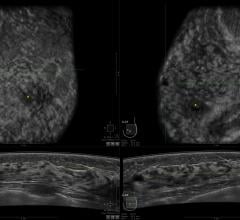 DCIS, ductal carcinoma in situ, mammography detection rates, Germany, Radiology journal