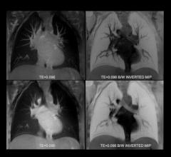 New MRI Technique Shows Effectiveness of Cystic Fibrosis Drug