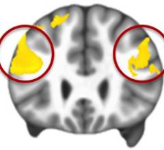 UNC School of Medicine, fMRI, autism, emotional regulation, brain, impaired