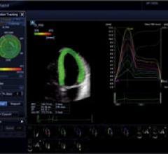 Normal dyssynchrony is demonstrated using Toshibas 3D wall motion tracking for the Aplio Artida ultrasound system. The left ventricle is color coded all green showing timing is in sync, while dyssynchrony would be color coded red.