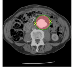 The DeepAAA algorithm, developed at the MGH & BWH Center for Clinical Data Science, accurately detected and measured an abdominal aortic aneurysm (AAA) in a CT image even though appearance of the AAA was complicated by a blood clot