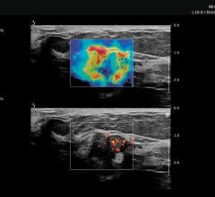 This is an example of 3-D ultrasound imaging on a breast, designed to help increase efficiency and diagnostic accuracy in any practice. Image courtesy of Hologic.