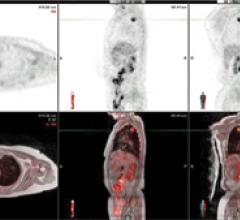 patient with lung cancer, MR/PET