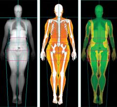 Body scans, Lunar iDXA