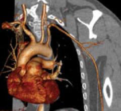 cardiac CT, cardiovascular computed tomography, what to look for in a CT scanner, advances in CT