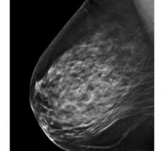 iCAD’s ProFound AI is one example of artificial intelligence used to improve detection of anomalies in radiological images. The software identifies breast lesions and assigns a score representing its confidence the lesion is malignant.