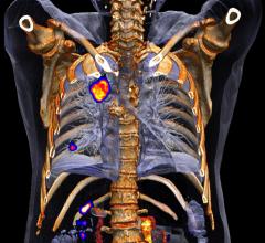 lung cancer, adenocarcinoma