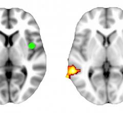 UNC School of Medicine, depression, rs-fcMRI, talk therapy, connectivity