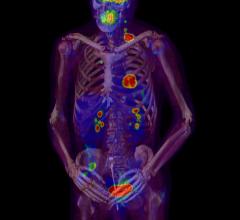 ASTRO guideline, bone metastases, pallliative radiation therapy, gold standard