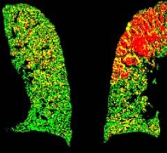 parametric response mapping PRM computed tomography CT COPD