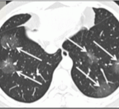 An axial CT image obtained without intravenous contrast in a 36‐year‐old male (Panel A) shows bilateral ground‐glass opacities in the upper lobes with a rounded morphology (arrows). #coronavirus #nCoV2019 #2019nCoV #COVID19 