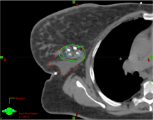 Study shows tissue marker reduces radiation target volumes, produces many other advantages