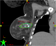 Study shows tissue marker reduces radiation target volumes, produces many other advantages