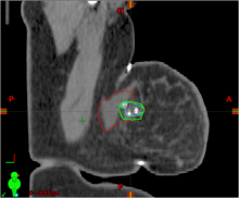 Study shows tissue marker reduces radiation target volumes, produces many other advantages