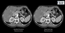 Comparison between CT images reconstructed using standard iterative reconstruction software and Canon’s new work-in-progress deep learning algorithm, called AiCE