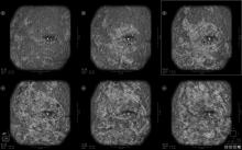 The benefits of adding whole breast automated ultrasound (ABUS) screening to clinical practice, enhancing cancer detection in the setting of dense breast tissue