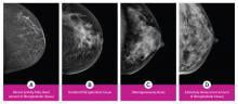 Breast density is divided into four categories, from lowest to highest amounts of fibroglandular tissue composition. Category A: Almost entirely fatty (least amount of fibroglandular tissue). Category B: Scattered fibroglandular tissue. Category C: Heterogeneously dense. Category D: Extremely dense (most amount of fibroglandular tissue).