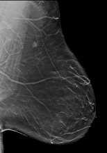 BI-RADS Category A: Almost entirely fatty (least amount of fibroglandular tissue). Understanding Dense Breasts