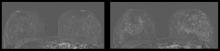 Figure 1. Left image shows breast MRI in 41-year-old patient without IUD. Right image shows increased parenchymal enhancement in the same patient 27 months after IUD placement.