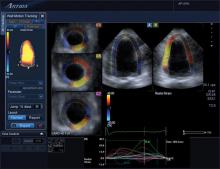 ultrasound, cardiotoxicity