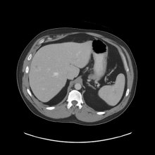 Routine scan of abdomen pelvis taken with the UW-Madison’s Revolution 256 CT scanner using the FDA-cleared reconstruction algorithm, called TrueFidelity.