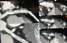 The use of metal artifact reduction software on this Aquilion Precision image allows clear visualization inside a coronary stent. The 0.25 mm high-resolution reconstruction also helps delineate the various components of plaque.