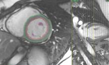 This study found cardiac MRI gadolinium-based contrast agents are safe for patient use. Overall, there were only 556 acute adverse effects in 145,855 contrast-enhanced MRIs, with only 47 being classified as severe. 