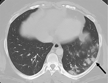 A 26-year-old man with history of diabetes and hypertension presented with 7 days of fever, chills, nausea, intractable vomiting, diarrhea and generalized weakness, but no specific upper or lower respiratory symptoms aside from mild shortness of breath. 