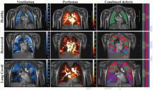 Free-breathing phase-resolved functional lung (PREFUL) low-field MRI at 0.55T with calculated parameters at an axial plane after automatic registration to a mid-expiration position and lung parenchyma segmentation. From left to right, representative color-coded images of functional show ventilation defects (VDP, blue), perfusion defects (QDP, red), ventilation/perfusion (V/Q match, green), ventilation/perfusion defects (V/Q defect, purple) in a healthy control (upper row, 7-year-old male), a participant rec