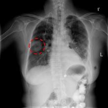 Chest X-ray AI Algorithm Correctly Identifies Lung Disease for Dubai Health Authority