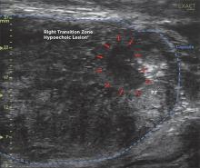 Visualization and targeting of a guided prostate biopsy using the ExactVu micro-ultrasound at a small Gleason 8 lesion. The small hypoechoic lesion is 0.49 cm x 0.61 cm (0.19” x 0.24”) in size. Biopsy was verified by clinical pathology.