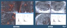 Figure 5. Doppler histogram assesses aggression (left) of rib metastasis (right).