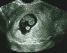 A transvaginal ultrasound image of a fetus at eight weeks. Imaged using a Philips HD15 system. Vivian Fornell