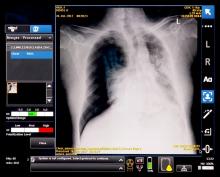 GE’s smart algorithm alerts technologist to possible complications in a chest radiograph. The combined algorithm and portable X-ray unit was shown as a work in progress at RSNA 2017.