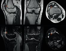 Siemens GOKnee3D scan visualize abnormalities (orange arrows) in the knee of a 14-year-old boy in orthopedic imaging. #RSNA2017, #RSNA17 