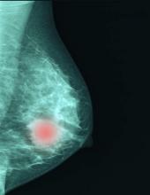 AI has the potential to help radiologists improve the efficiency and effectiveness of breast cancer imaging