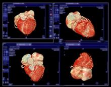 Among the many notable trends in CT, one of the fastest growing is the coronary CT angiography market, as witnessed at RSNA23