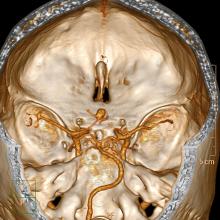 As the world, particularly the imaging community, is aware, disruptions in a pharmaceutical supply chain have impacted the global availability, and shortage of, iohexol iodinated contrast media (ICM), a common agent used in a multitude of CT and X-ray exams.