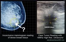 Breast image using mammogram vs. high-resolution ultrasound.