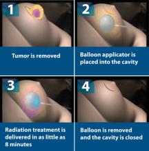 brachytherapy, radiation dose