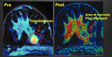 MRI, HIFU