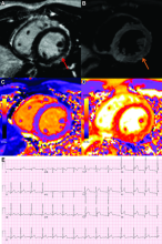 COVID-19 vaccine associated myocarditis.