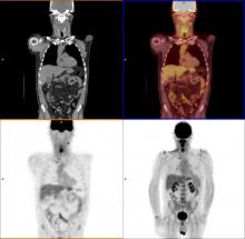 pet scan cancer