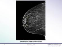 42-year-old female patient presenting a yearly routine screening mammogram in 3D. Right CC shows an opacity in the anterior aspect of the breast in the retroareolar area.