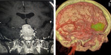 This image from  Hoag Memorial Hospital looks at virtual reality reconstructions versus conventional 2-D images, as shown