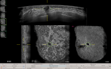 This image depicts ABUS images with QVCAD results