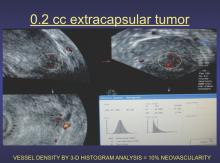 Histogram-volumetric study shows extracapsular tumor has a 10 percent malignant vessel density, which can be used as a reference measurement to assess treatment effect on serial scans