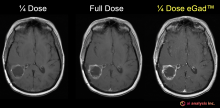 This image is of an 80 kg woman with a newly diagnosed IDH-wildtype glioblastoma