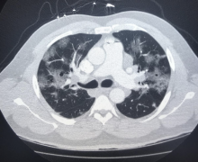 The use of cardiovascular computed tomography angiography (CCTA) is one of the areas that has seen a sudden increase in use and value since the start of the ongoing COVID-19 pandemic. 